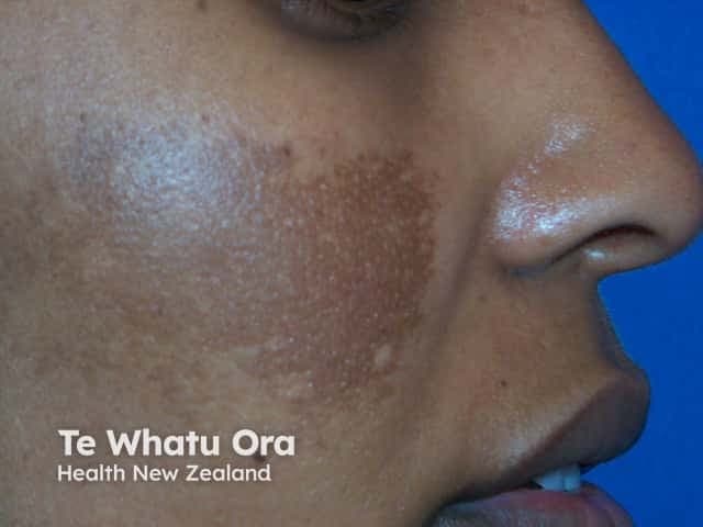 The Hidden Dangers of Skin Bleaching